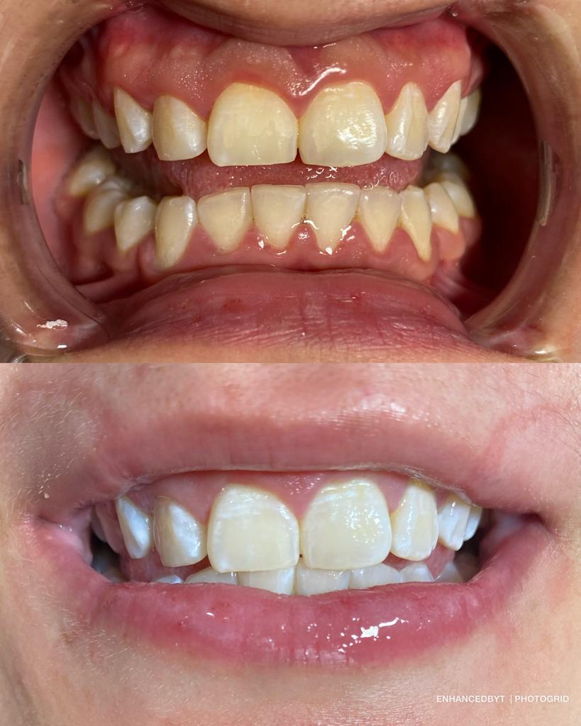 Cosmetic Teeth Whitening