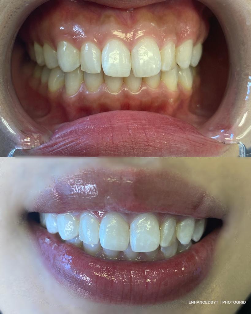 Cosmetic Teeth Whitening