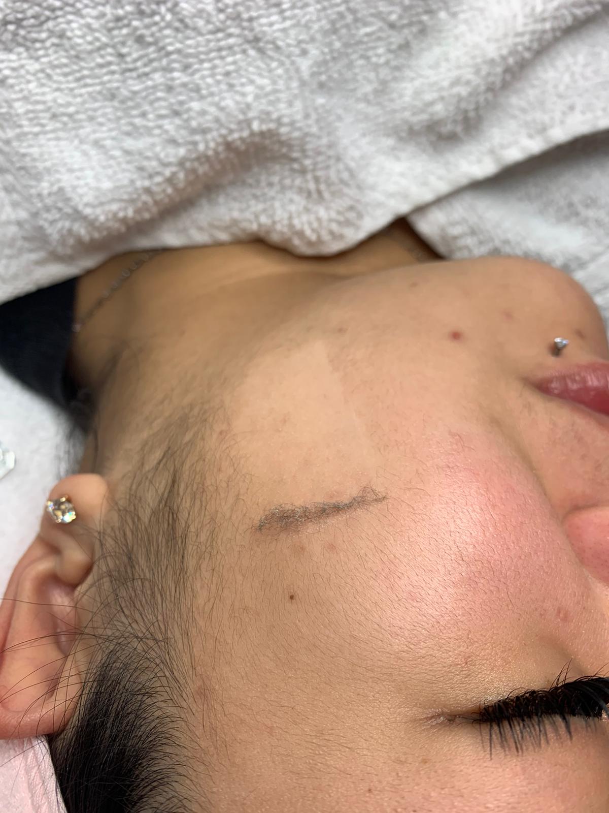 Close-up of a dermaplaning treatment being performed on a client's face in Vancouver's Yaletown and Toronto's Yorkville. The skilled technician gently glides a surgical scalpel over the skin, exfoliating and revealing a smoother complexion