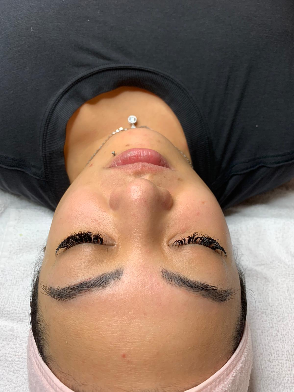 Close-up of a dermaplaning treatment being performed on a client's face in Vancouver's Yaletown and Toronto's Yorkville. The skilled technician gently glides a surgical scalpel over the skin, exfoliating and revealing a smoother complexion
